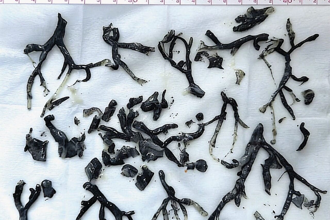 Black Gunk Found in Man’s Lungs Exposes an Even Darker Side of Wildfire Smoke