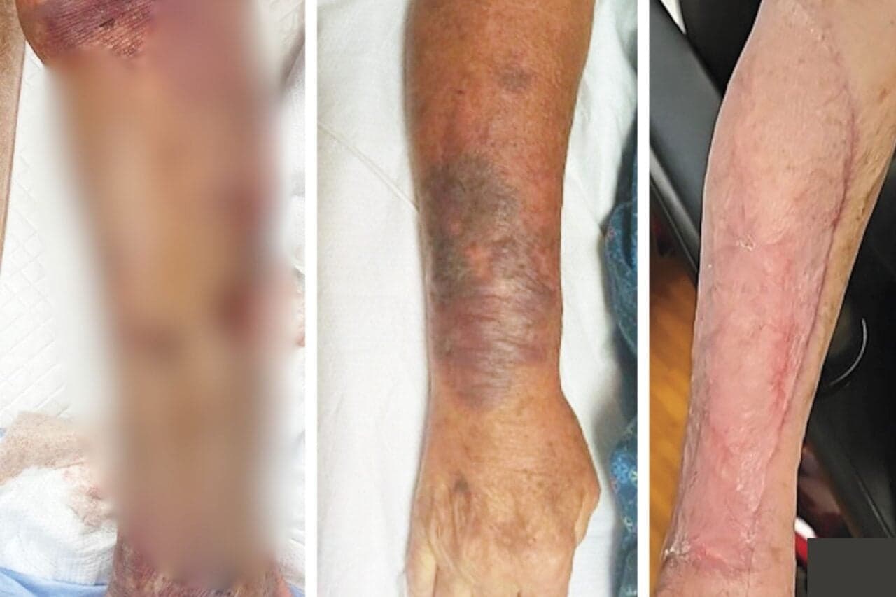 This Is What a Leg Ravaged by ‘Flesh-Eating’ Bacteria Looks Like